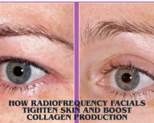 How Radiofrequency Facials Tighten Skin And Boost Collagen Production