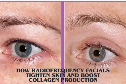 How Radiofrequency Facials Tighten Skin And Boost Collagen Production