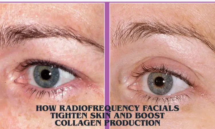 How Radiofrequency Facials Tighten Skin And Boost Collagen Production